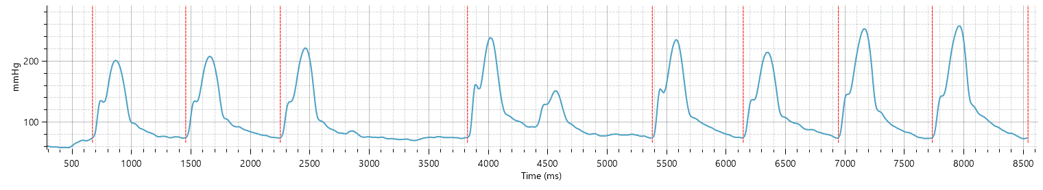 Example of Irregular rhythm strip from standard BP+ measurement