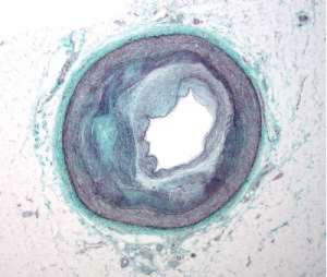 BP+ Arterial Stiffness