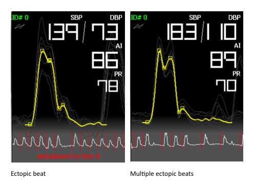 BP+ Ectopic Beat